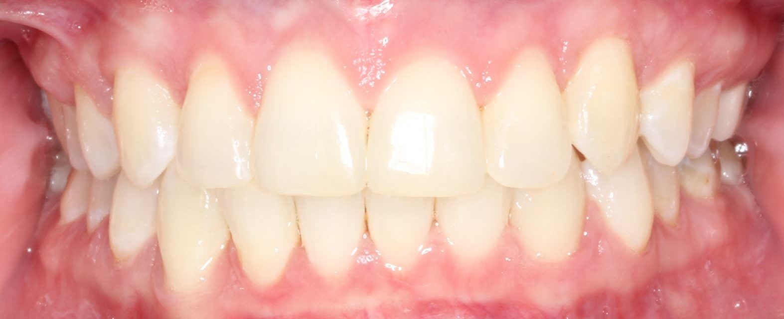 After Impacted Canine2